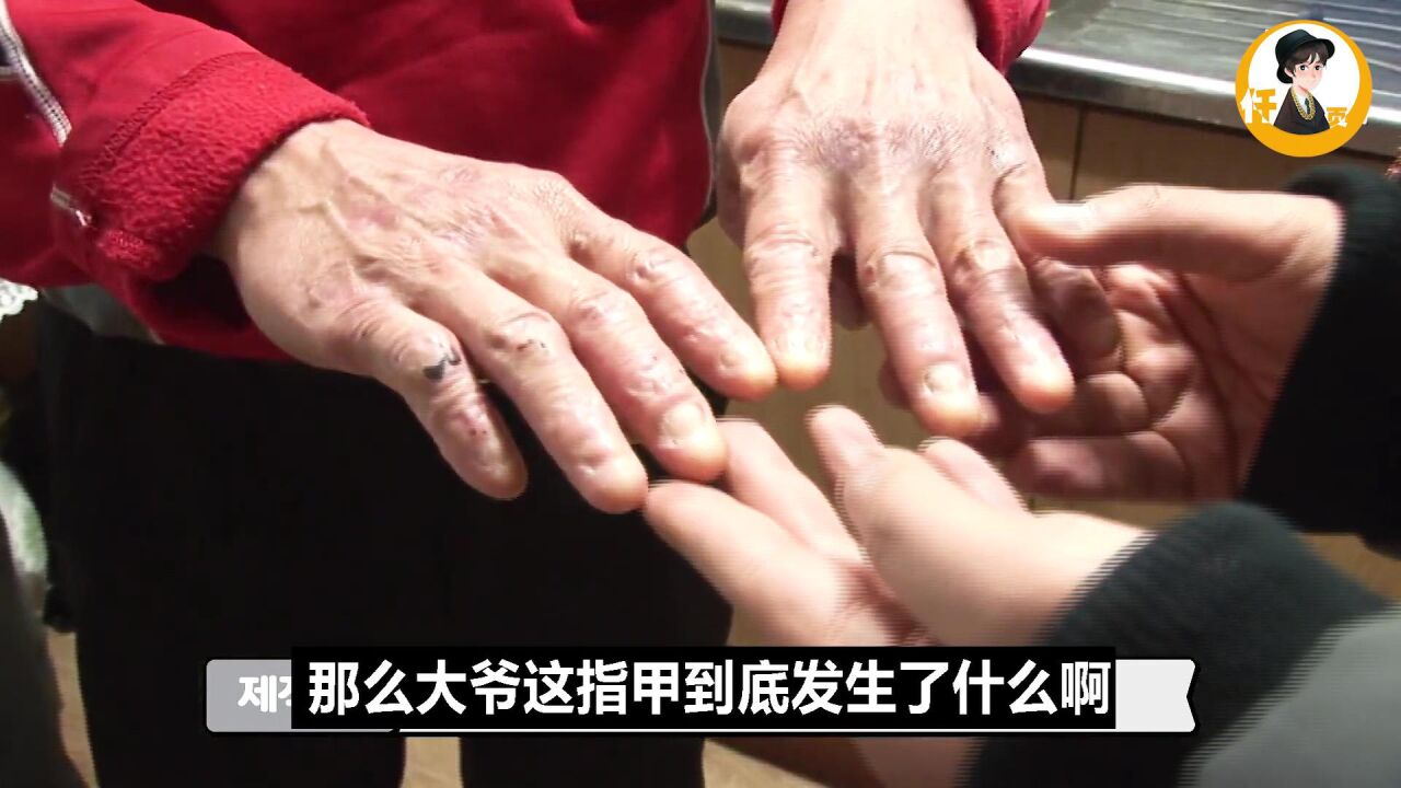 大爷十根脚趾没有任何指甲