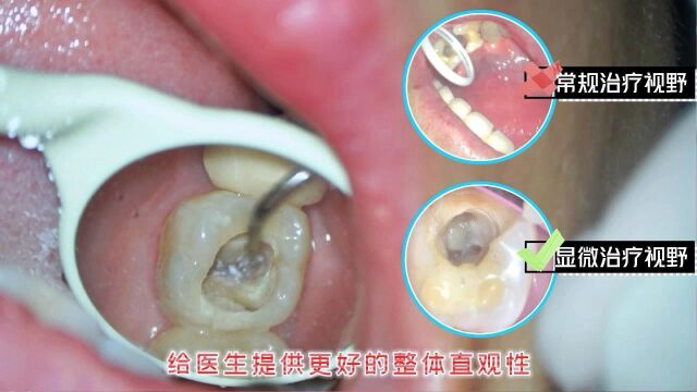 牙科日常|口腔显微镜𐟔즠𙧮ᦲ𛧖—的“精准”神器