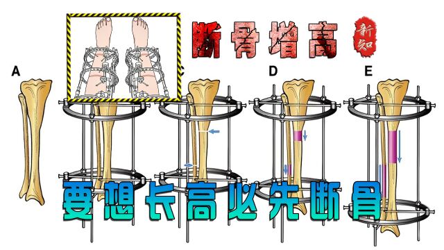 想要长高必先断骨的增高方式.断骨增高究竟有多可怕?