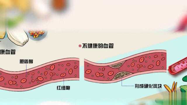 戳图→高血脂怎样影响心脑血管疾病?