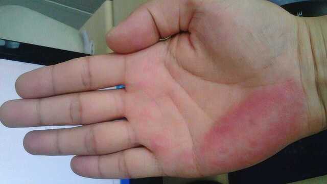 手掌突然发红,可能是肝硬化的前兆,要警惕!