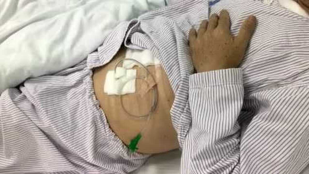 空肠营养管的家庭护理