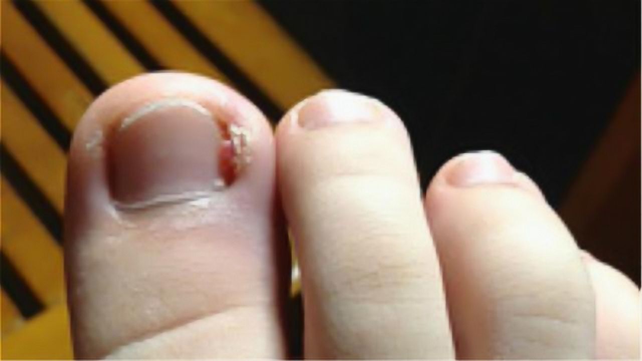 指甲长进肉里太疼了只花几毛钱教你恢复方法早清楚早受益