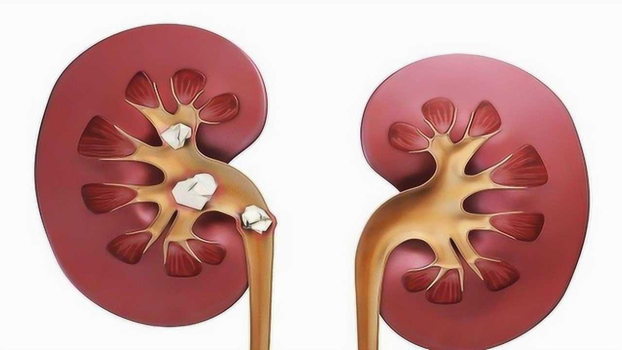 3d演示肾结石是怎样排出的网友看着都疼