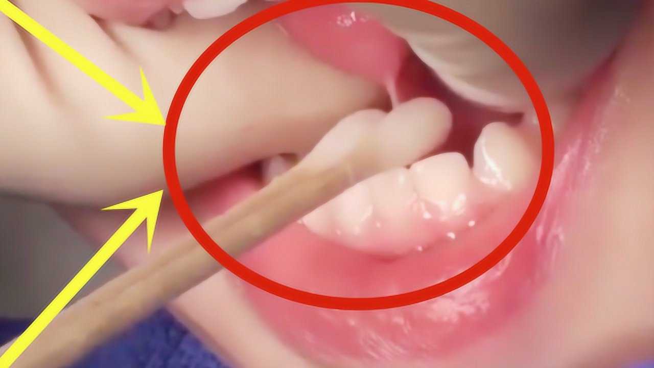 为什么小孩刚出生要"剪舌根"?医生说出原因,涨知识了