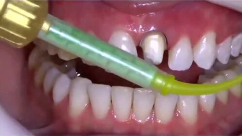 牙套,把牙齿磨成这么大小,你愿意接受吗?