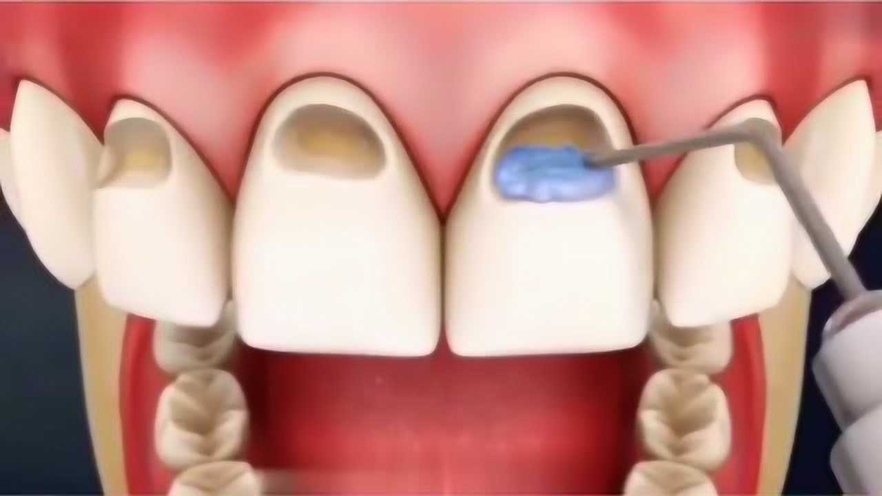 損傷的牙釉質及時修復不然旁邊的牙齒也會壞掉3d動畫還原過程