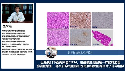 会选会用会看-丛文铭教授带你读懂肝癌免疫组化诊断