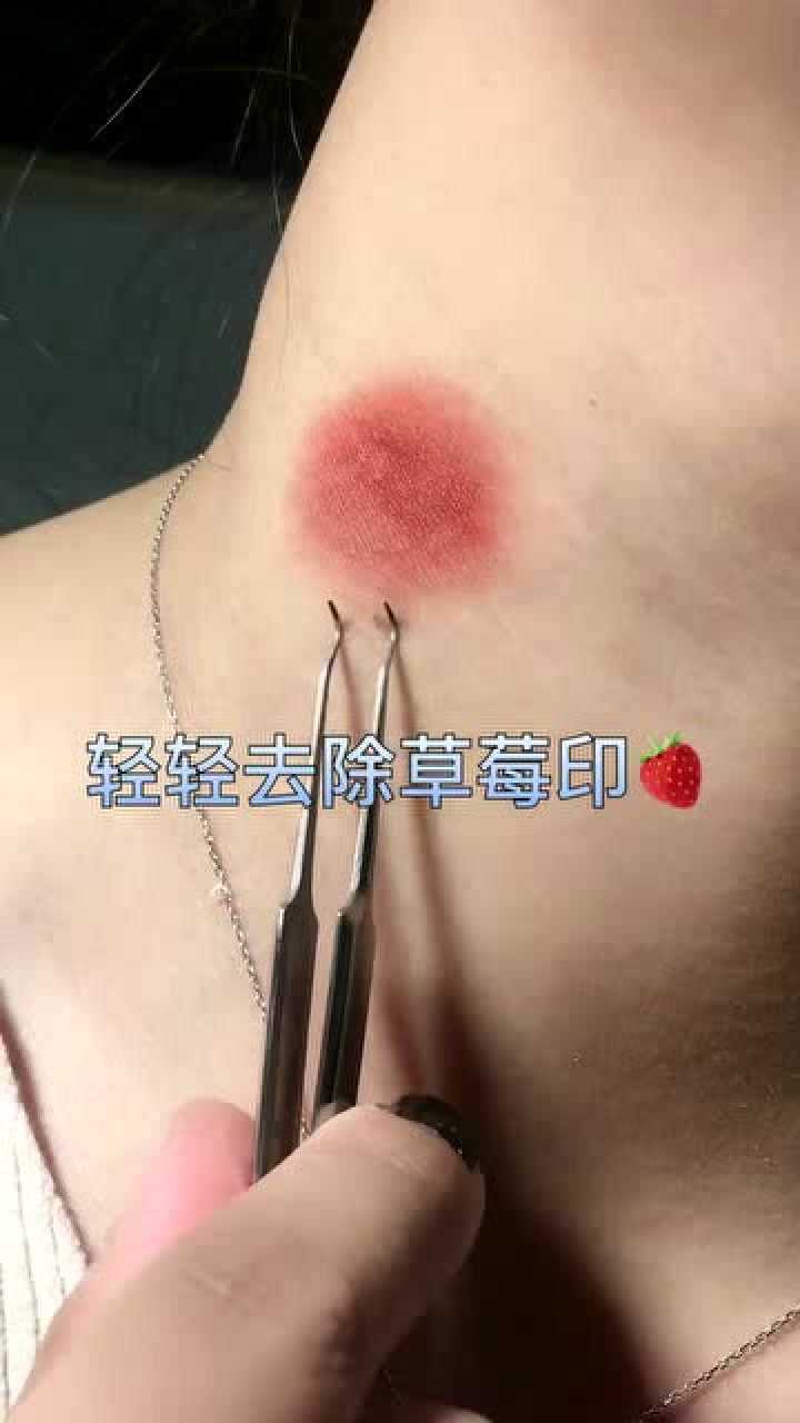 脖子上的草莓印有救了婆婆看見再也不尷尬了