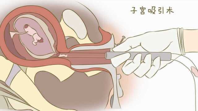 3D还原“人流手术”全过程,看完这3种方式,你还敢打胎吗?