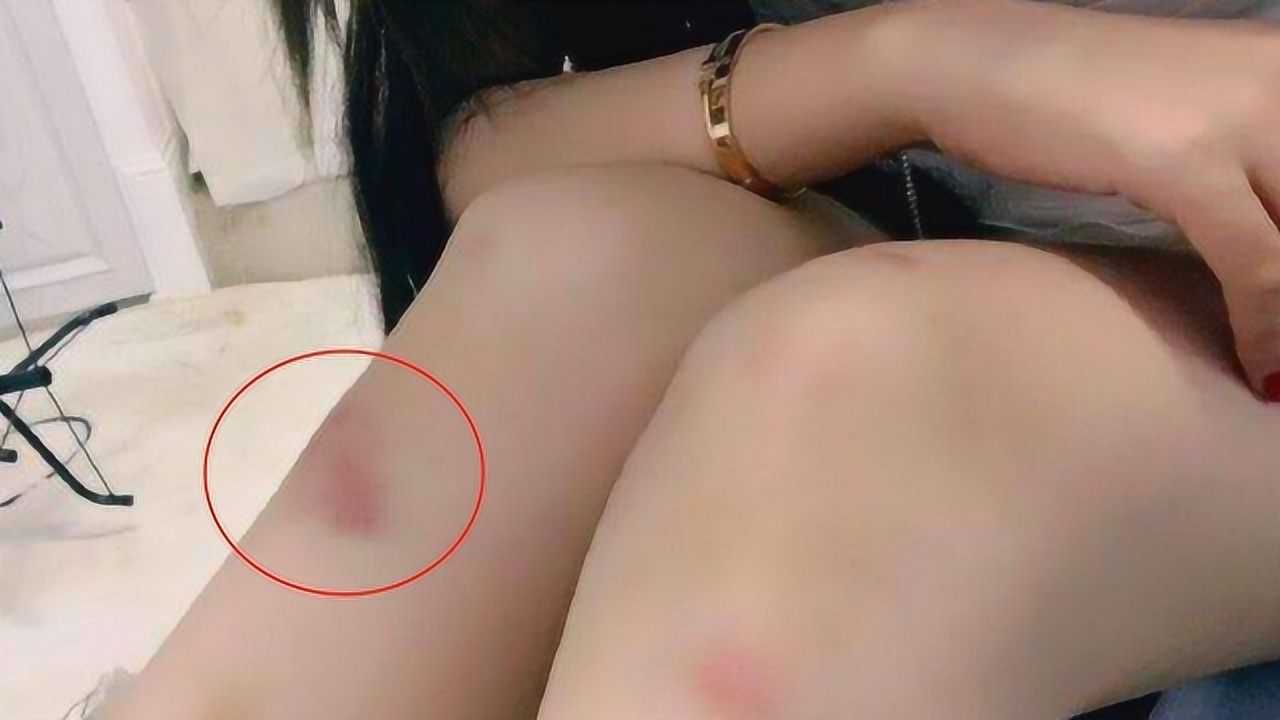 为什么漂亮女生的膝盖经常会有淤青这是怎么回事看完有些羡慕