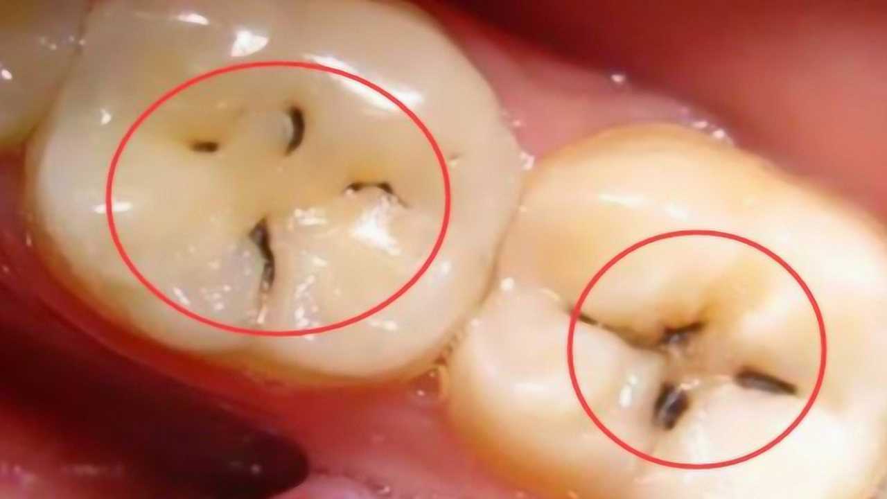 蛀牙真是被虫子吃空的吗看3d大片演示全过程涨知识了