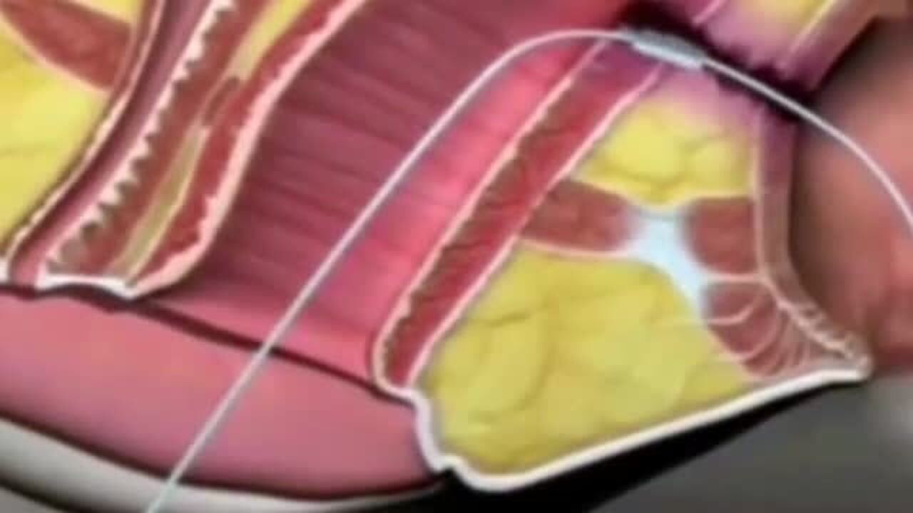 肛瘘是怎么通过手术治愈的，3D动画演示过程，网友：关键是价格！_腾讯视频