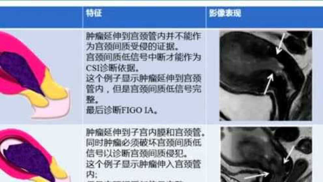 基于FIGO分期的子宫内膜癌MRI分期最新指南解读-刘晨_高清1080P在线观看平台_腾讯视频