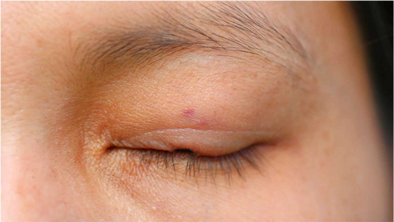 眼皮上长了脂肪组织"小肉粒"该如何解决?提醒:别再干傻事
