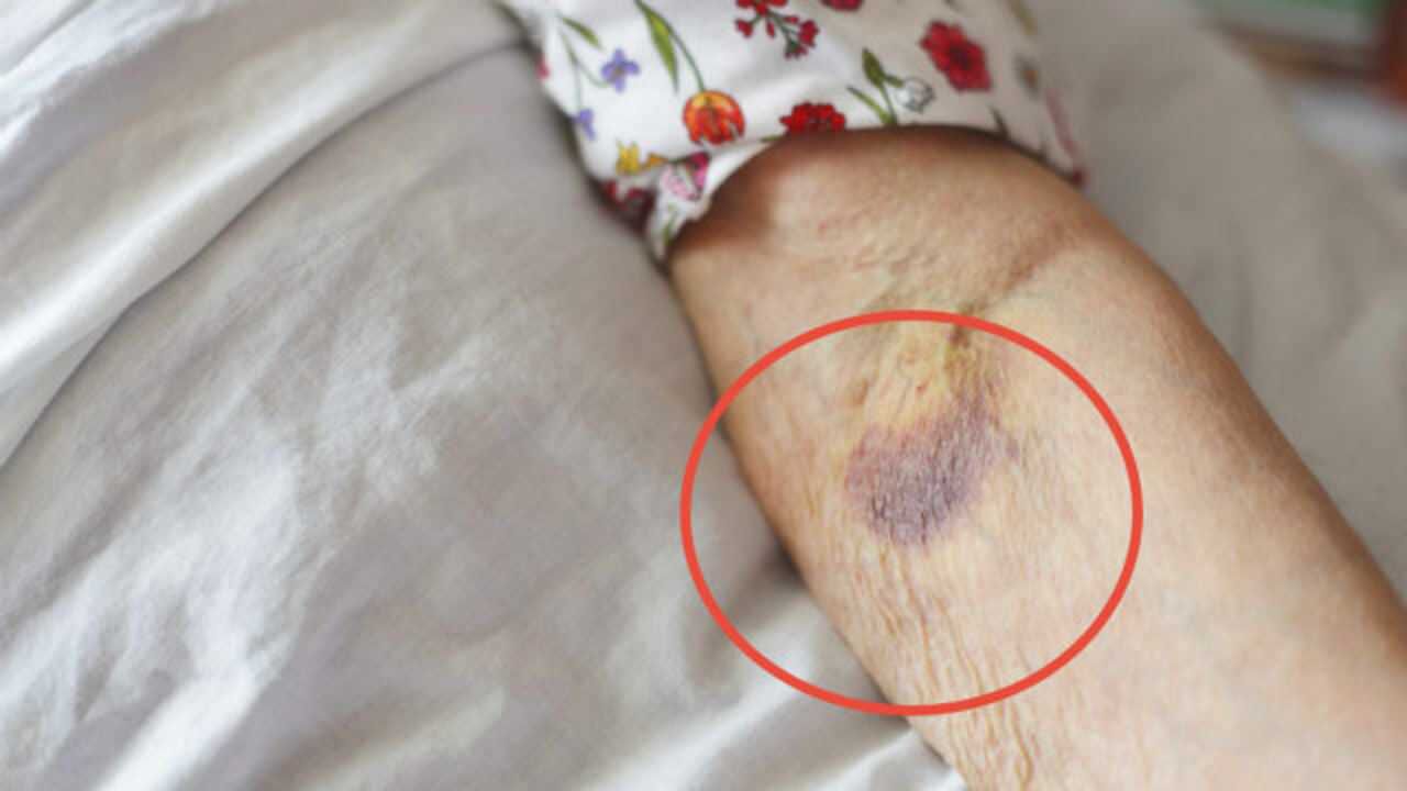 白血病早起之后皮肤上若有这个标志警惕血癌已潜伏