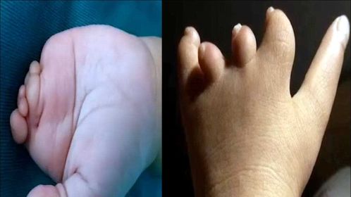 新生儿手指少关节图片图片