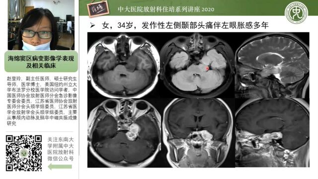 海绵窦区病变影像学表现及相关临床中大赵登玲