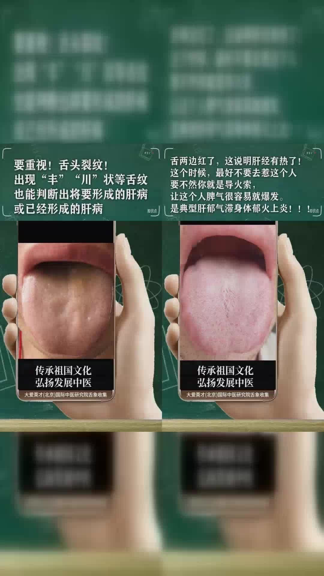 研究舌象:舌苔厚腻舌,脾肾虚寒,肝郁,痰浊上泛