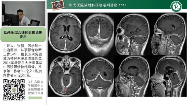 低颅压综合征的影像诊断要点中大张健