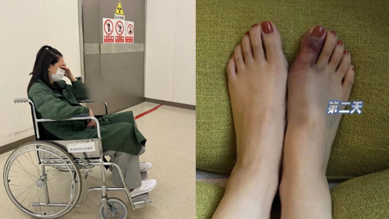 演员佟晨洁大脚趾骨折!紫红一片起水泡出脓血,坐轮椅出行好无助