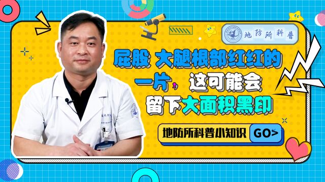 长在屁股和大腿根部的真菌感染皮肤病,不能大意后果可能很严重!