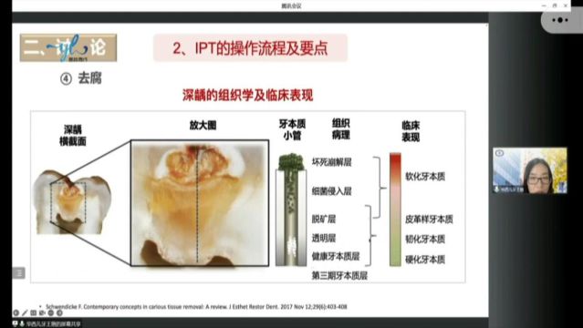 年轻恒牙深龋间接牙髓治疗一例——华西口腔王艳老师