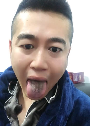 男子确诊后舌头牙齿全变黑,网友:感染"黑株"?