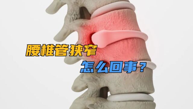 腰椎管狭窄,到底是怎么回事?听医生详细讲解,怎么应对有底了