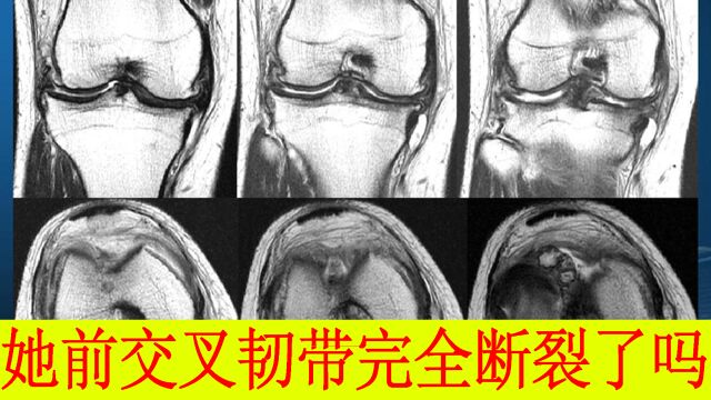 前交叉韧带是否断裂是否应该手术,把握住五点你就能判断