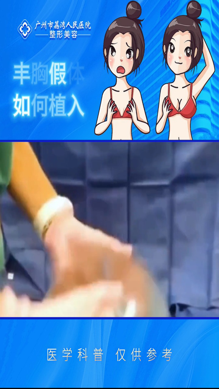 假体隆胸植入过程