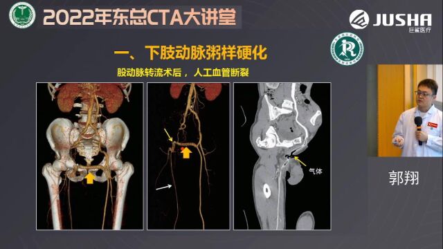 四肢血管扫描技术、后处理及诊断要点东部战区总医院郭翔