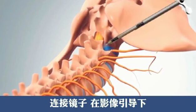 腰椎间盘突出如何治疗?这个方法一定要知道