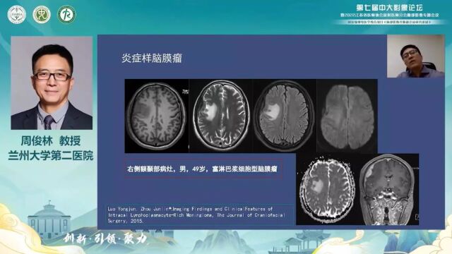 非典型性脑膜瘤定义及概述兰州大学第二医院周俊林