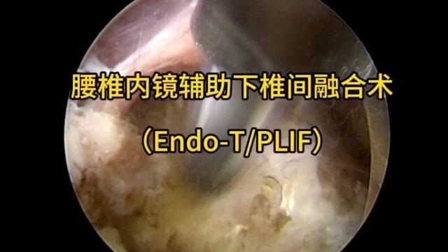 腰椎镜下融合全集(腾讯版)