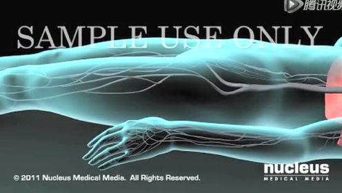 深静脉血栓和肺栓塞-3D医学动画