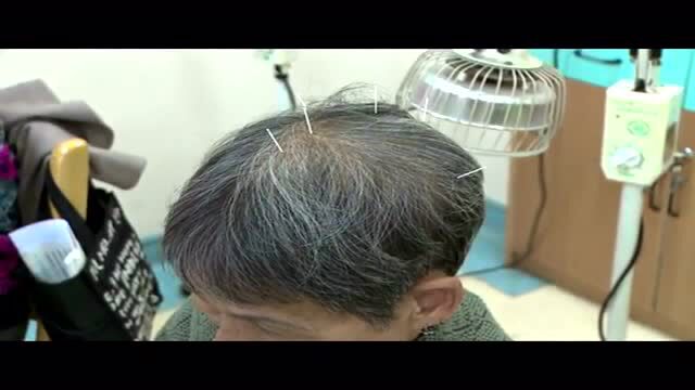 中医针灸头皮针治疗类风湿关节