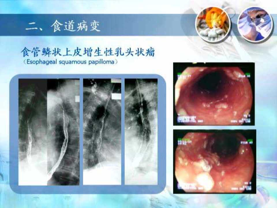 食道、胃病变X线及CT诊断_腾讯视频