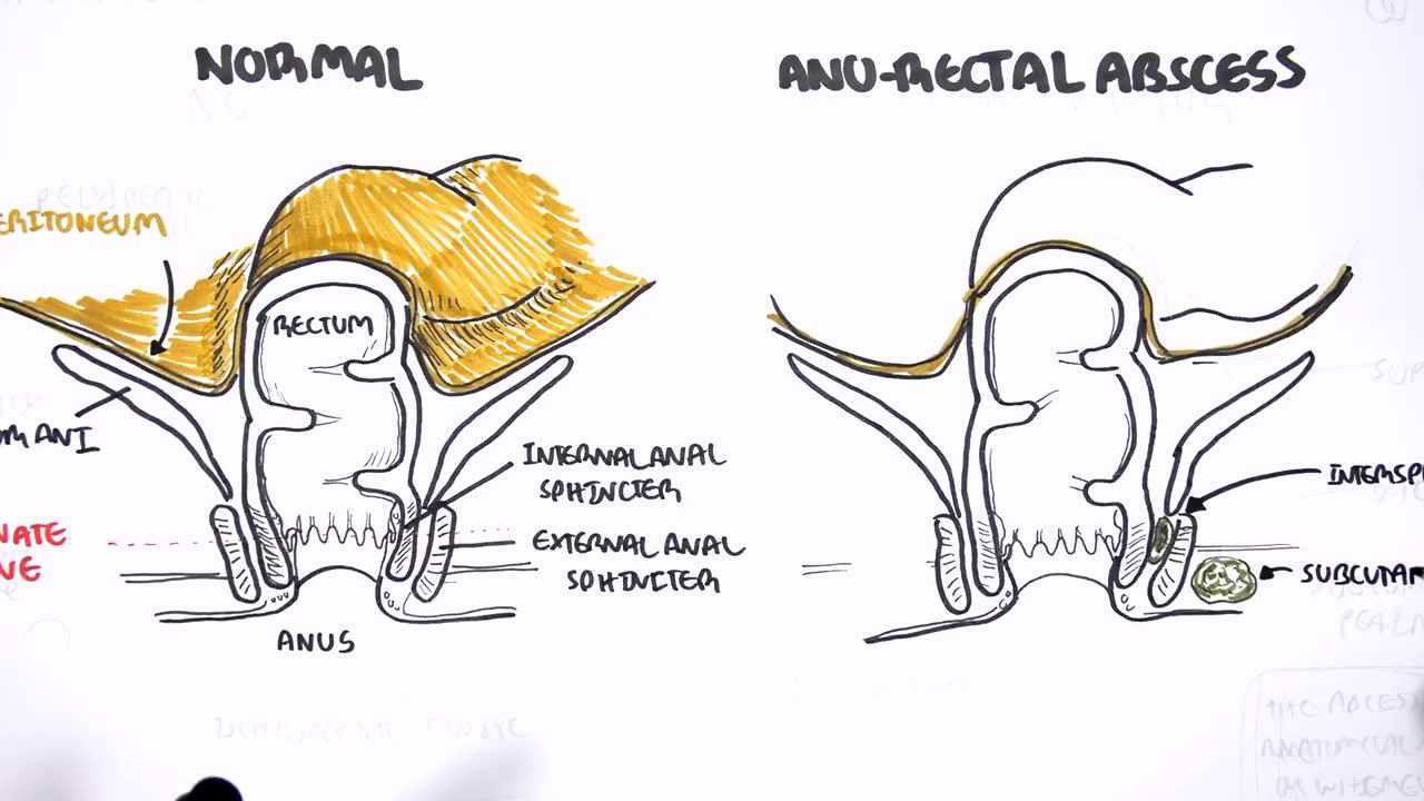课件:anorectal abscess(肛门直肠脓肿 )