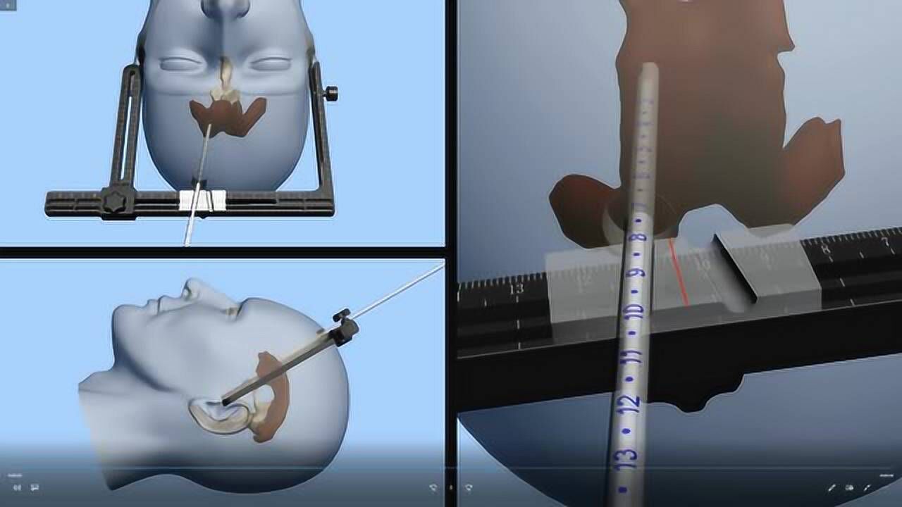 侧脑室精准穿刺