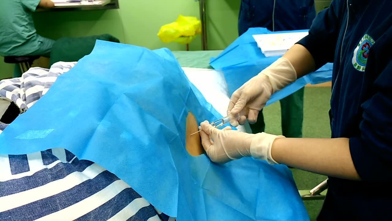 剖宫产手术细针微创腰麻