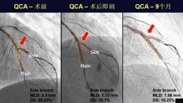 华医心诚专家讲堂:赵昕教授“BEYOND研究DCB在叉病变中的应用”