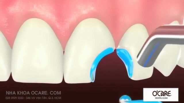 动画演示门牙缺损通过树脂补牙的全过程!