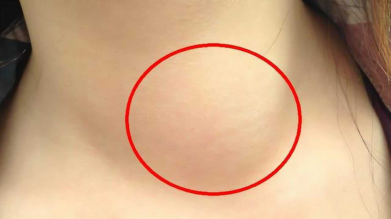 不论男女,只要脖子上出现这样的肿块,别怀疑,可能是肺癌前兆