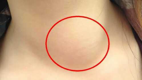 不论男女,只要脖子上出现这样的肿块,别怀疑,可能是肺癌前兆