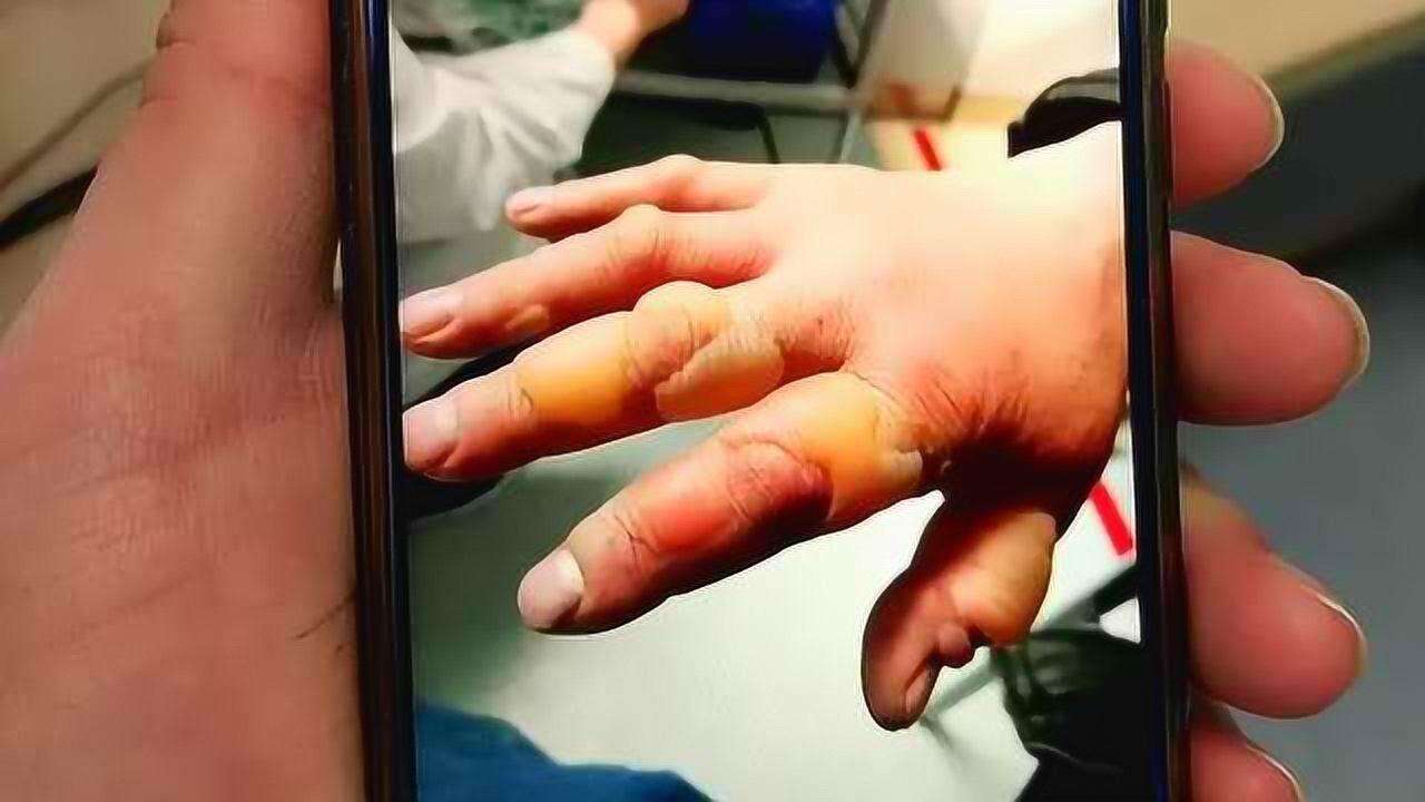 男子自行修理空调,手被液态氟冻在管子上,遭冻伤险截指