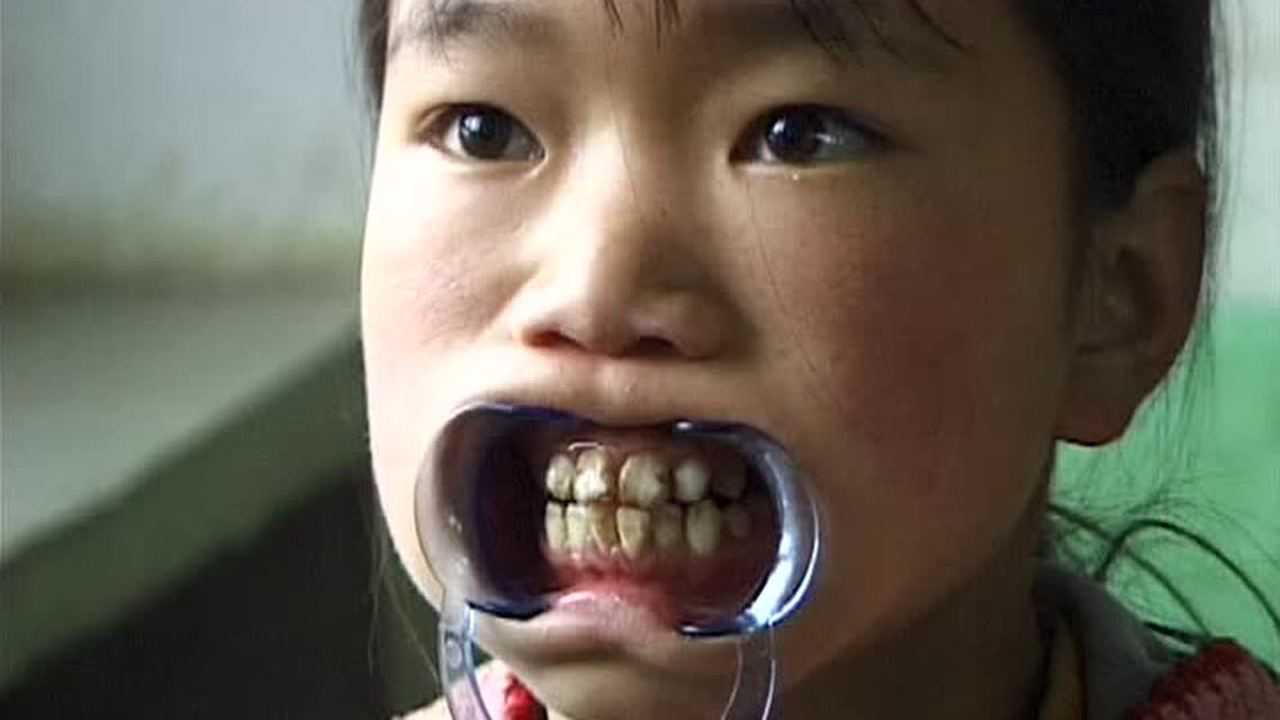 饮水型地方性氟中毒危害与防治_腾讯视频
