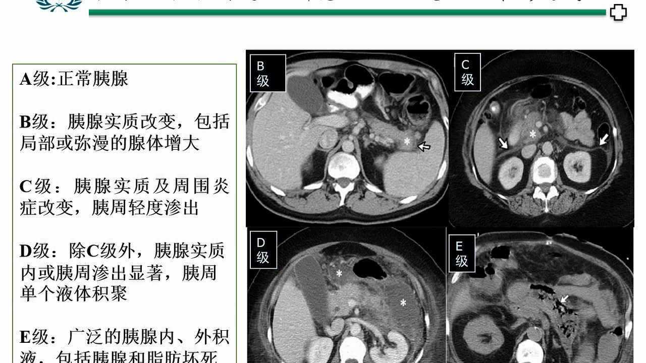 急性胰腺炎课件2_高清1080P在线观看平台_腾讯视频