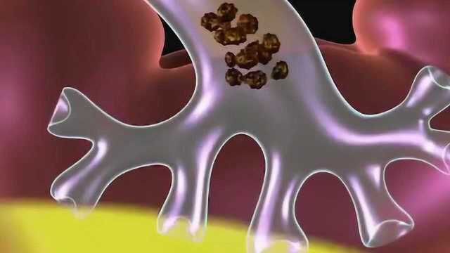 结石如何是在人体内打碎的,医生用3D动画演示了一下,长见识了!