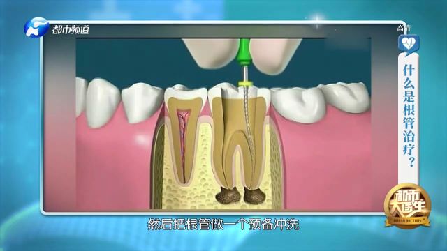 什么是根管治疗?根管治疗会损伤牙齿吗?都市大医生现场讲解